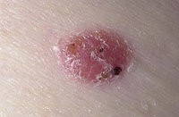 Mole a század - a lap alján, jobbra és balra, vagyis az eltávolítása, fotó (érték) Mole a század - a lap alján, jobbra és balra, az érték törlés, fotók