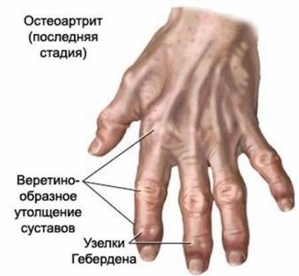 Csapok az ízületek az ujjak okoz, tünetei, kezelése
