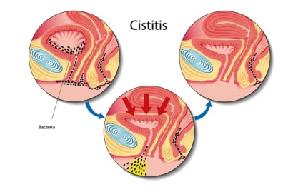 Tünetegyüttes súlyosbodása és kezelésére cystitis