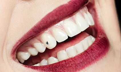 Skys fogak árak, képeket és az értékeléseket, a telepítés kristályok a fogak