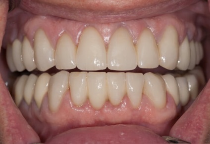 Skys fogak árak, képeket és az értékeléseket, a telepítés kristályok a fogak