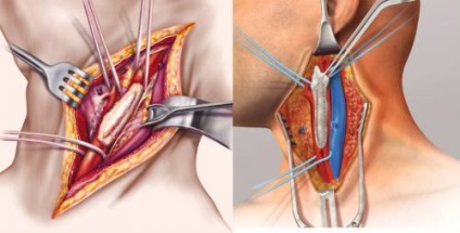 Arteria carotis nyakán személy, az ő betegsége és a stentbeültetés sebészet
