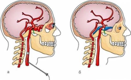 Arteria carotis nyakán személy, az ő betegsége és a stentbeültetés sebészet