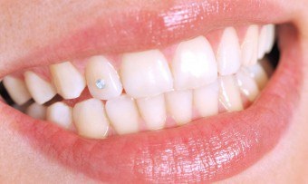 A modern irányzatok kristályok a fogak