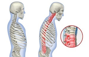 Spondylitis mi ez, tünetek, kezelés (szeronegatív csigolya) Spondylitis mi ez, tünetek, kezelés