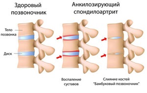 Spondylitis mi ez, tünetek, kezelés (spondylitis tünetek) Spondylitis mi ez, tünetek, kezelés