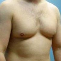 Eltávolítása gynecomastia az ára 15.000 rubelt