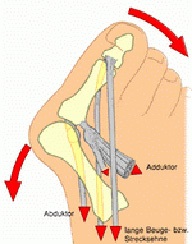 Valgus deformitás hüvelykujj (hallux valgus)