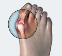 Valgus deformitás hüvelykujj (hallux valgus)