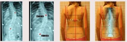 Fokú és típusú scoliosis orvosi besorolás - diagnózis scoliosis (faj) Fokú és típusú scoliosis orvosi besorolás - diagnózis gerincferdülés