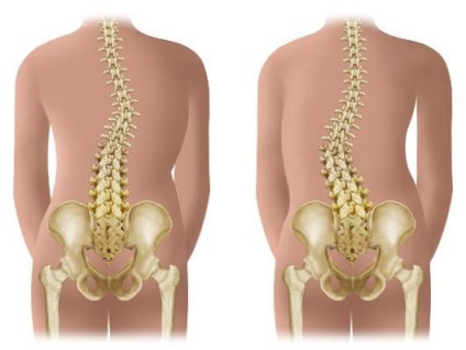 Fokú és típusú scoliosis orvosi besorolás - diagnózis gerincferdülés