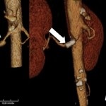 Arteria carotis interna atherosclerosis, trombózis, aneurizma