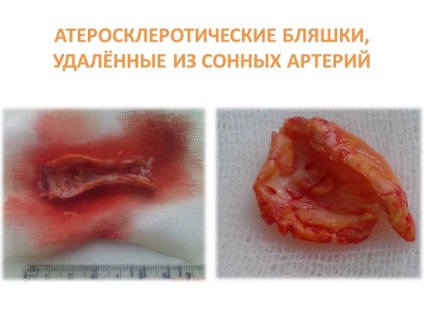 Arteria carotis interna atherosclerosis, trombózis, aneurizma