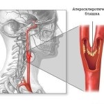 Arteria carotis interna atherosclerosis, trombózis, aneurizma