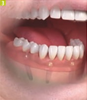 Azt akarom implantátumok fogászati Sumlinski (implantátumok) Azt akarom implantátumok fogászati Sumlinski