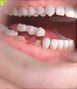 Azt akarom implantátumok fogászati Sumlinski (betölti az állkapocs csont) Azt akarom implantátumok fogászati Sumlinski