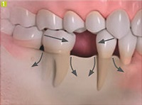 Azt akarom implantátumok fogászati Sumlinski (fog) Azt akarom implantátumok fogászati Sumlinski