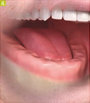 Azt akarom implantátumok fogászati Sumlinski (kivehető fogpótlás fix) Azt akarom implantátumok fogászati Sumlinski