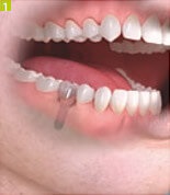 Azt akarom implantátumok fogászati Sumlinski (rágás betölteni az állkapocs csont) Azt akarom implantátumok fogászati Sumlinski