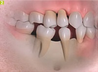 Azt akarom implantátumok fogászati Sumlinski (kivehető fogpótlás fix) Azt akarom implantátumok fogászati Sumlinski