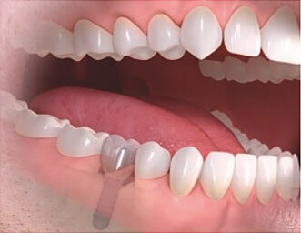 Azt akarom implantátumok fogászati Sumlinski (rágás betölteni az állkapocs csont) Azt akarom implantátumok fogászati Sumlinski