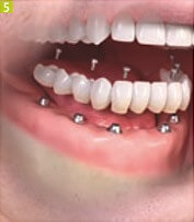 Azt akarom implantátumok fogászati Sumlinski (implantátumok) Azt akarom implantátumok fogászati Sumlinski