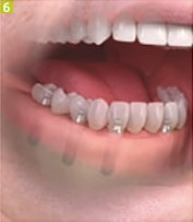 Azt akarom implantátumok fogászati Sumlinski (implantátumok) Azt akarom implantátumok fogászati Sumlinski