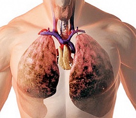 A folyadék a tüdőben az onkológiában, a rák - kezelésére és megelőzésére
