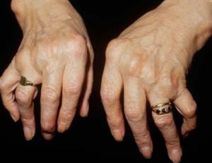 Nappali rheumatoid arthritis - a tünetek, a kezelés, megelőzés