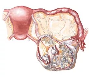 Laparoszkópos petefészek ciszta eltávolítás (Cystectomia ovarii)
