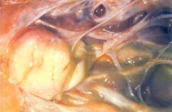 sérülések és a vállízület kezelése juharlevél ízületi gyulladás esetén