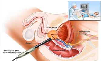 masaj prostatei prostatita prostatita crește burta