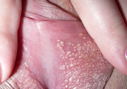 Veruca Genitala (Negi) | BASH Bradford