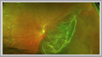 látássebészeti glaukóma