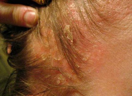 Ekcéma, seborrhoeás dermatitis és a hajhullás