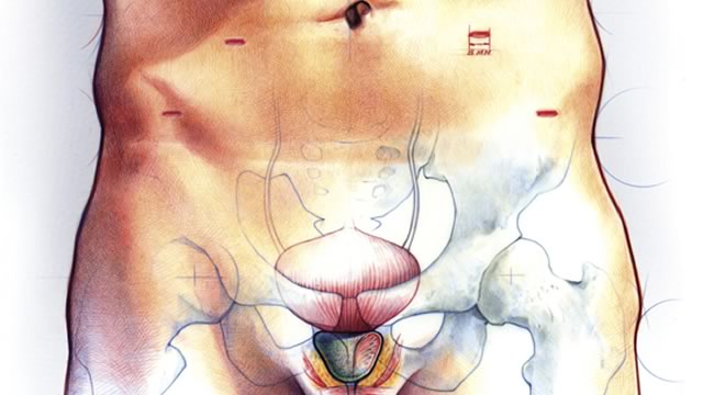 hogyan lehet csökkenteni a prosztata méretét Prostatitis a férfiak kezelési gyakorlatokban
