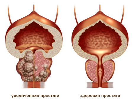 Prosztata-megnagyobbodás tünetei és kezelése
