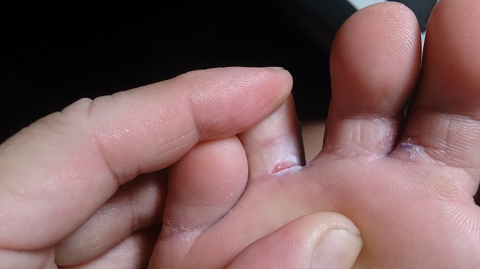 Ujjbegy repedése - Bőrbetegségek