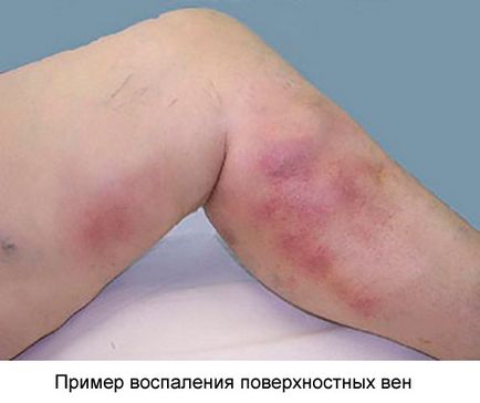 belső visszérgyulladás tünetei a visszér lábain lévő vénák eltűnnek
