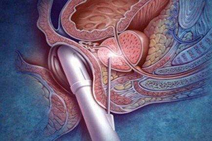 Intra-vese reszorpciós edény és artériás aorto-mesenterialis „csipeszek”
