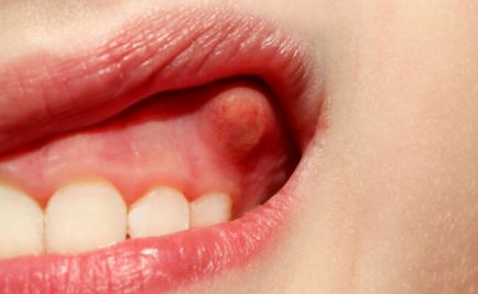 Az íny duzzanata, rossz lehelet Ínygyulladás: Tünetek és kezelése | Lévai Dental