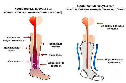 picioarele dureroase sunt varicoase zbor pentru varicoza