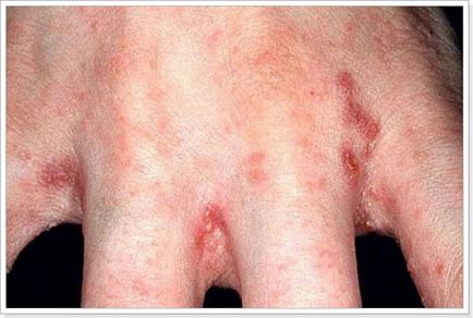 allergiás kontakt dermatitis