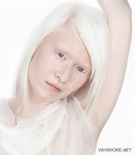 látvány emberek albínók)