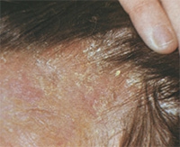 A seborrheás ekcémás fejbőr kezelése