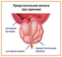 proceduri cu noroi pentru prostatită)