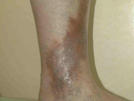Eczema pe picioare în tratamentul venelor varicoase, Prezentare generală - eczeme varicoase