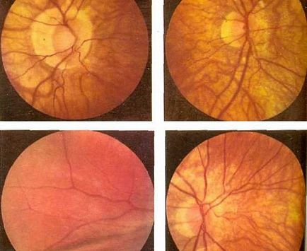 látás, hogyan lehet javítani a látás rövidlátását speciális eljárások a látás javítására