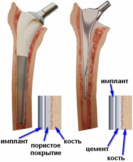 Csípőprotézis műtét - leírása, okai és kezelése - Csípő endoprotezis