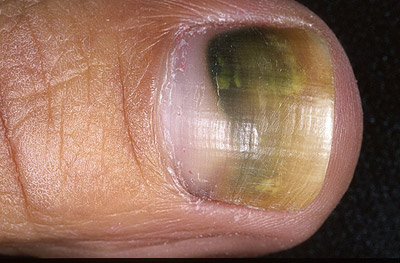 Gomba körmöket (onychomycosis) tünetek, szakaszok, diagnózis